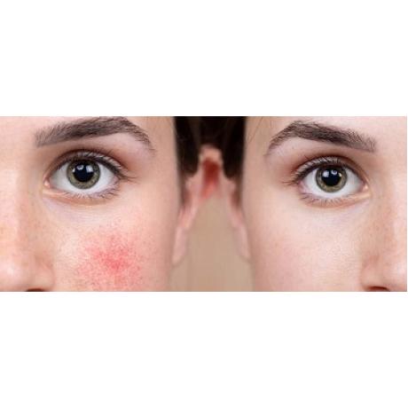 Уход за кожей лица при куперозе
